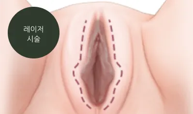 소음순 미백 효과